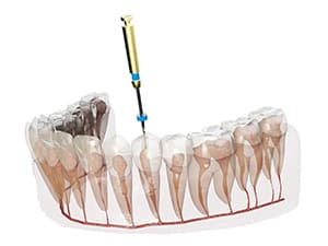 つくばの歯医者「SUNNY DENTAL CLINICつくば」の根管治療