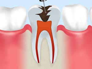 汚染歯質の除去
