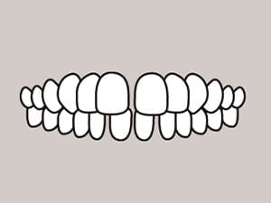 空隙歯列（すきっ歯）