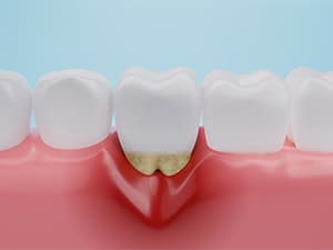 歯周病は歯を失う最大の原因です