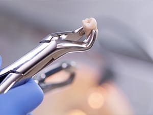 つくばの歯医者「SUNNY DENTAL CLINICつくば」では即日抜歯も対応可能