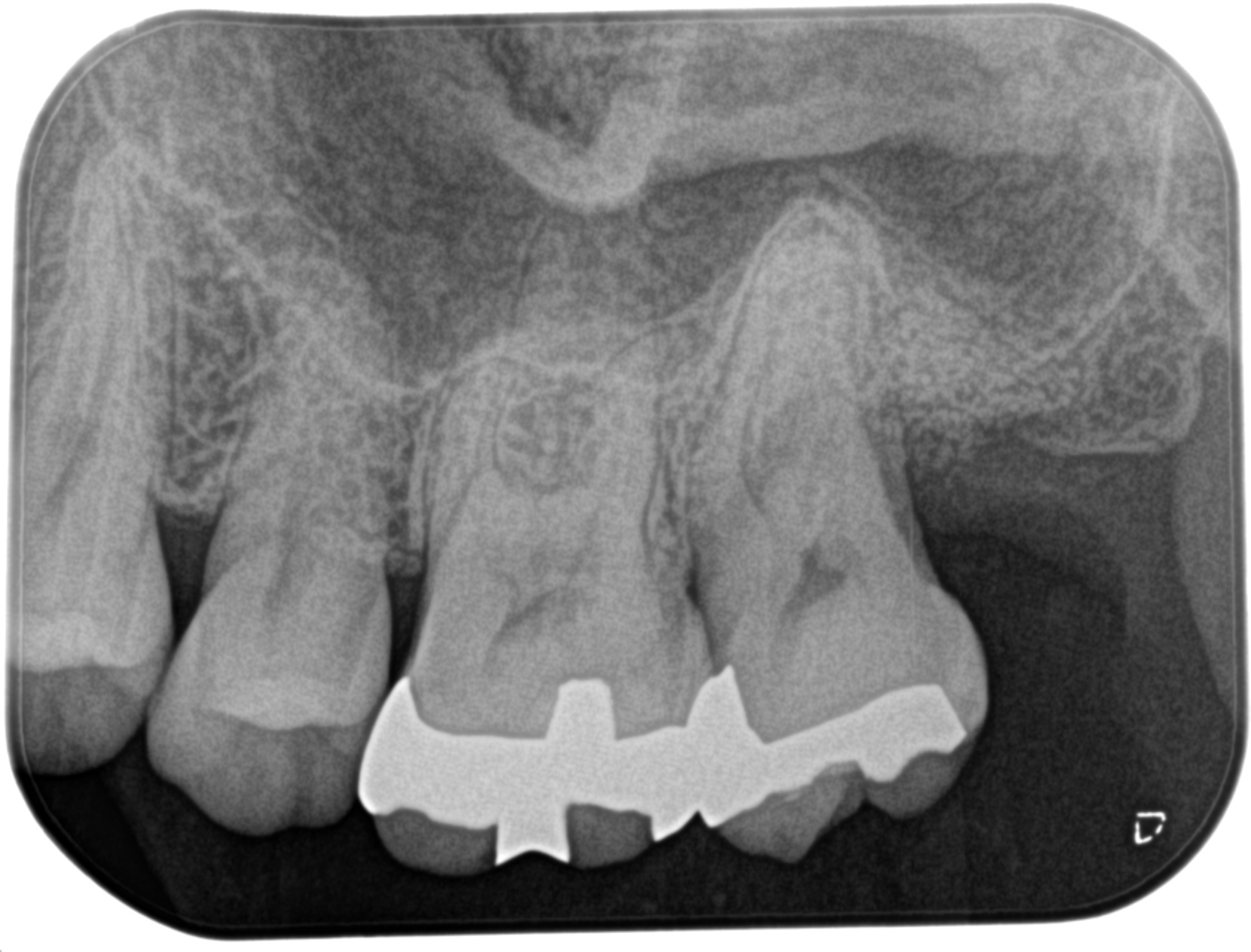 歯周組織再生療法🦷