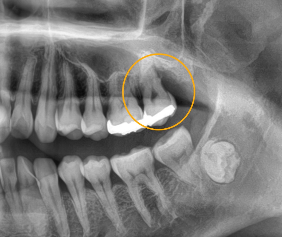 歯周組織再生療法🦷